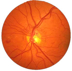 Macular Degeneration Orlando